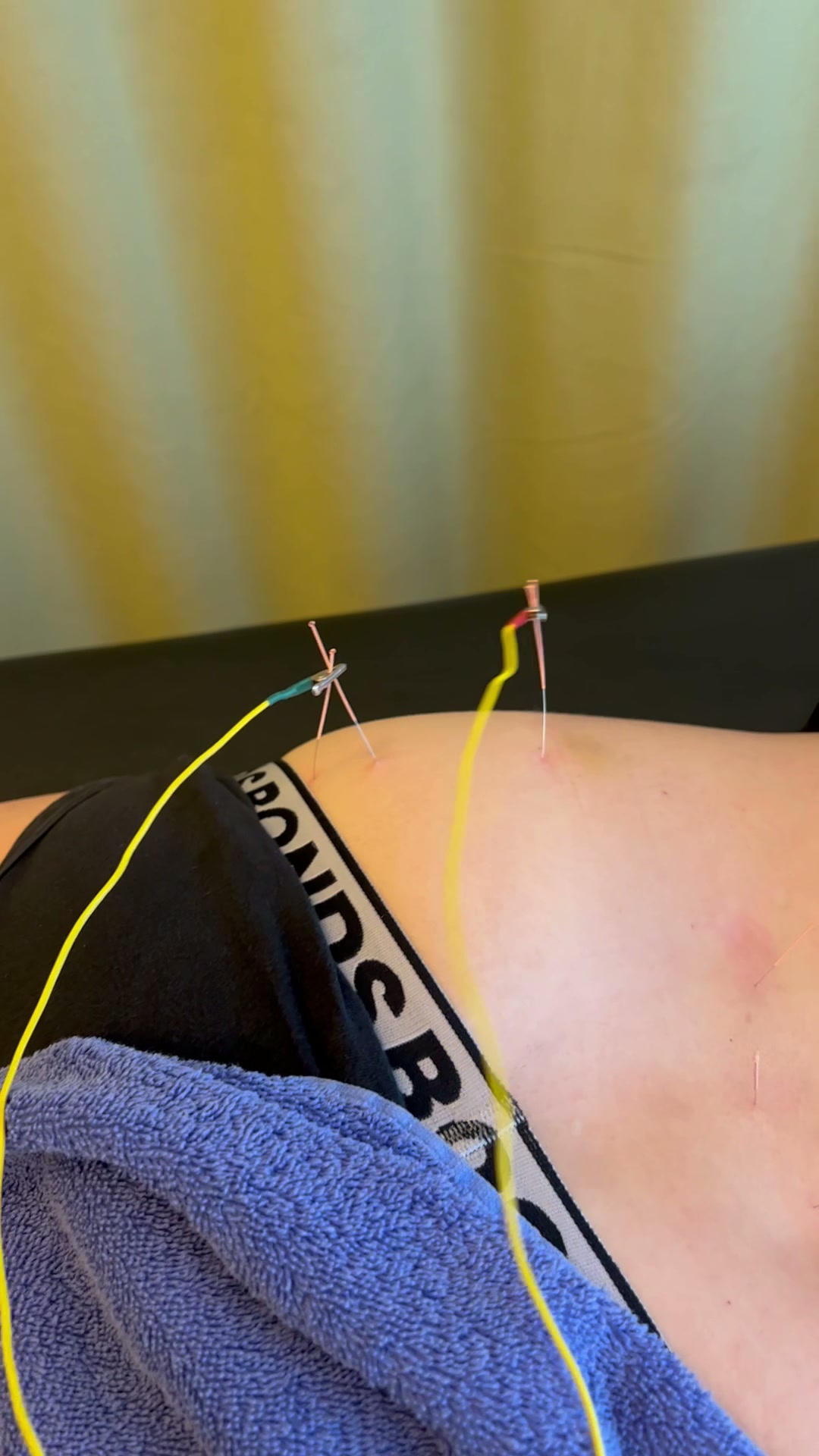 Electroacupuncture